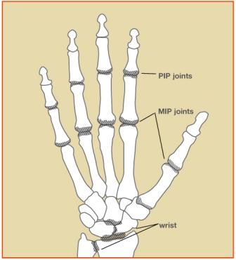 rheumatoid arthritis Image 1