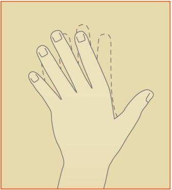 rheumatoid arthritis Image 2