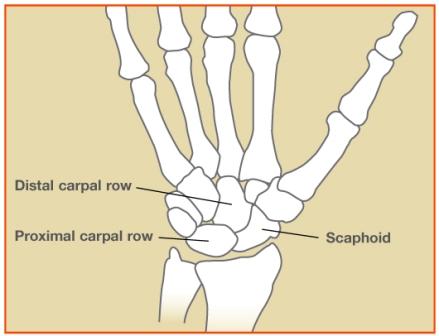 Schaphoid Fracture Image 1