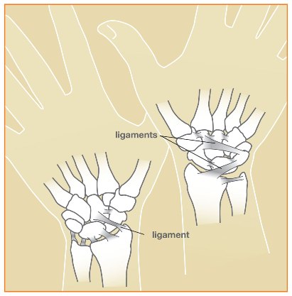 Wrist Sprains Image 1