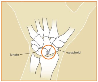 Wrist Sprains Image 2