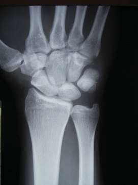 Wrist Sprains Image 3